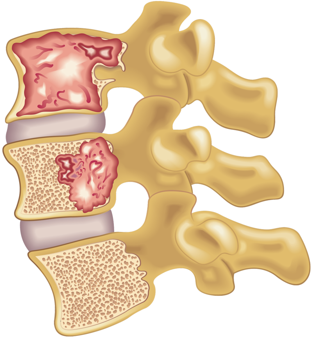 Multiples Myelom